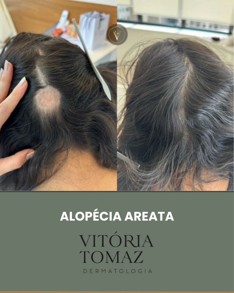 Alopécia AREATA