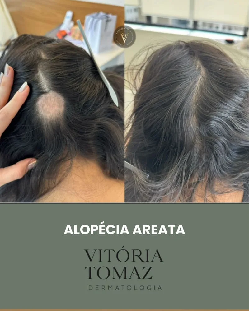 Alopécia AREATA