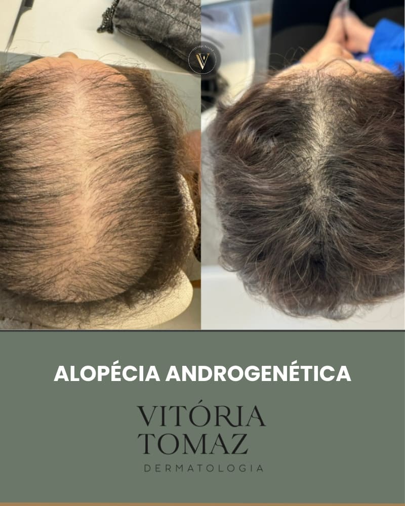 Alopécia Androgenética Feminina