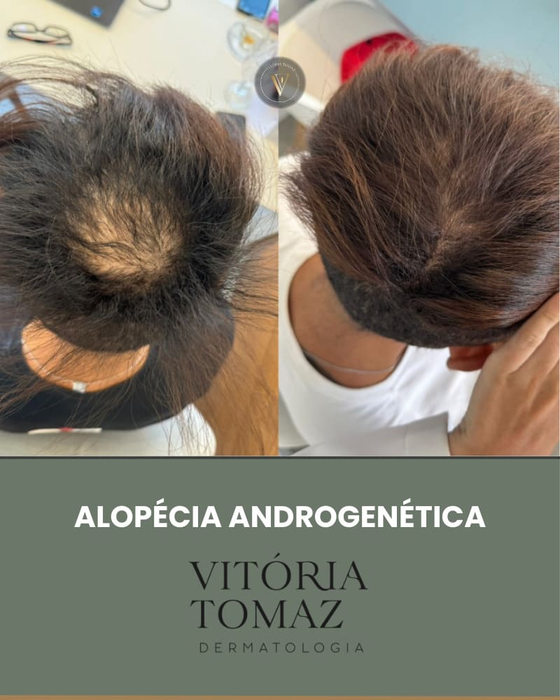 Alopecia Androgenética Masculina