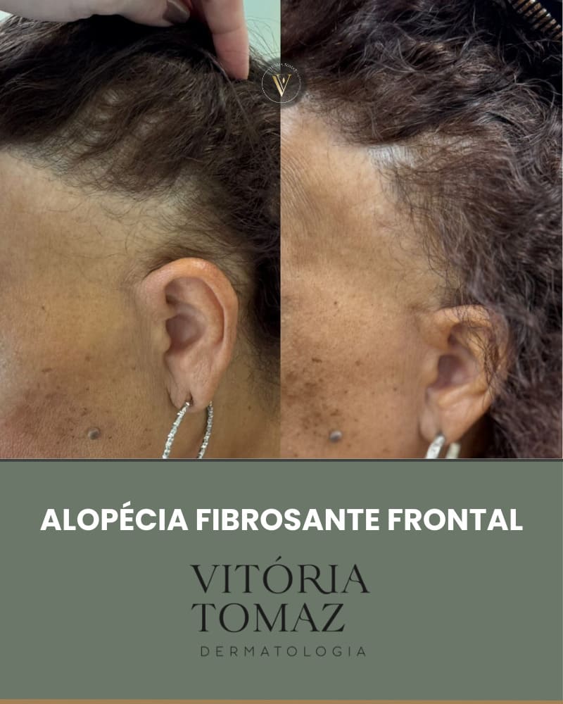 Alopécia FIBROSANTE FRONTAL