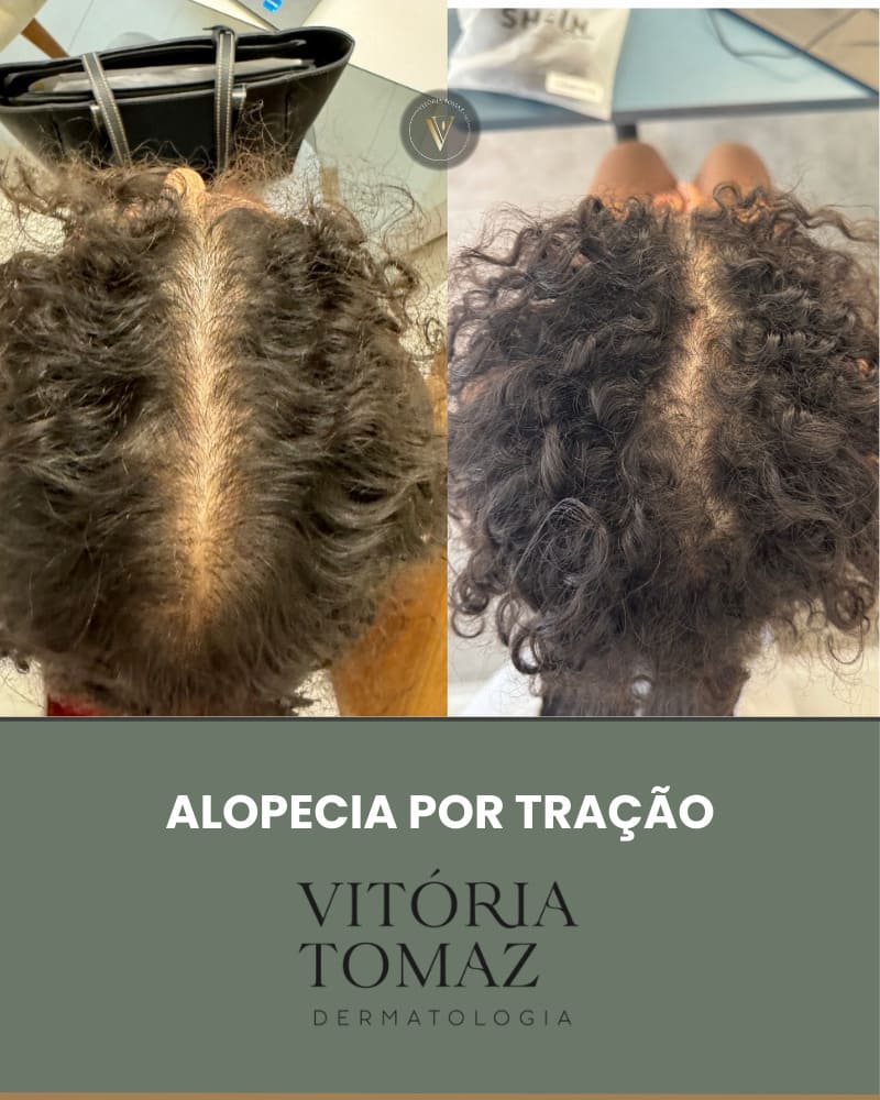 Alopecia por tração