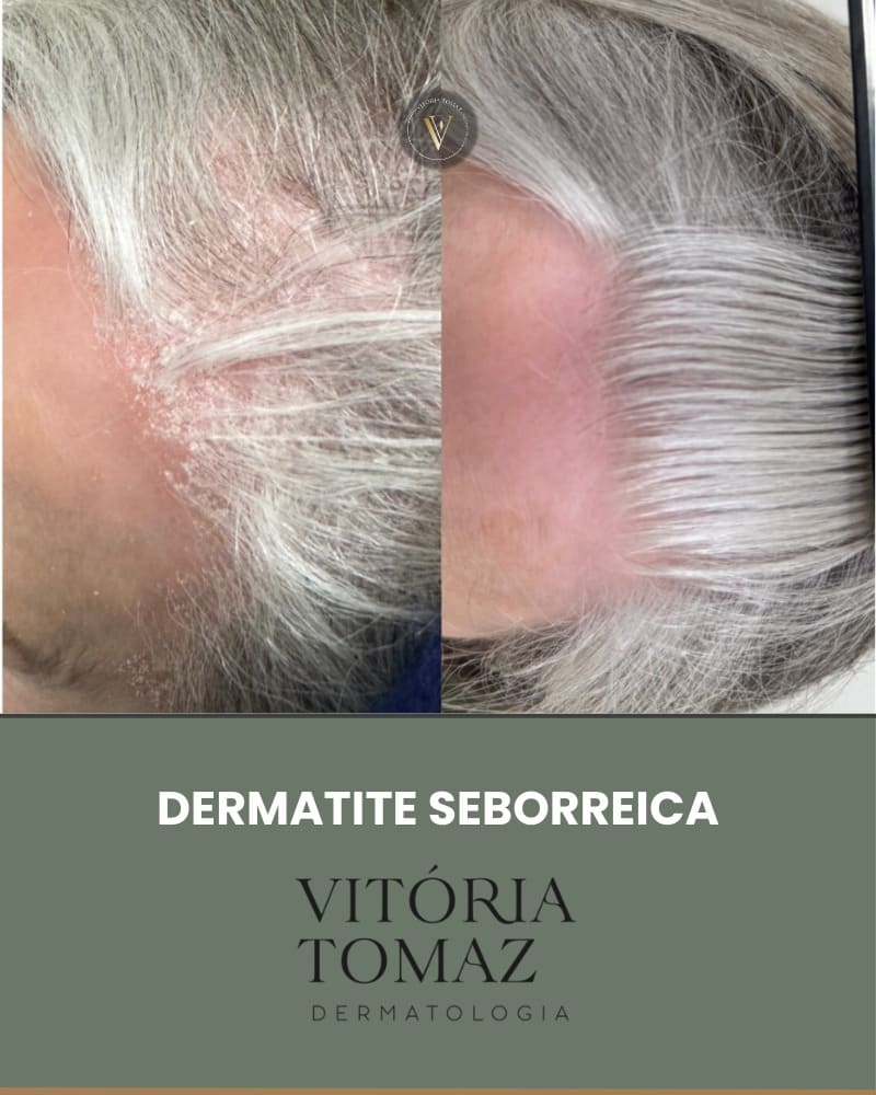 Dermatite seborreica