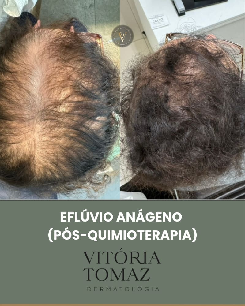 Eflúvio Anágeno (Pós-Quimioterapia)