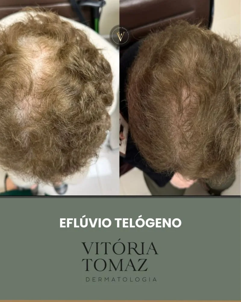 Eflúvio Telógeno