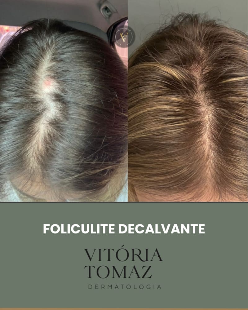 Foliculite Decalvante