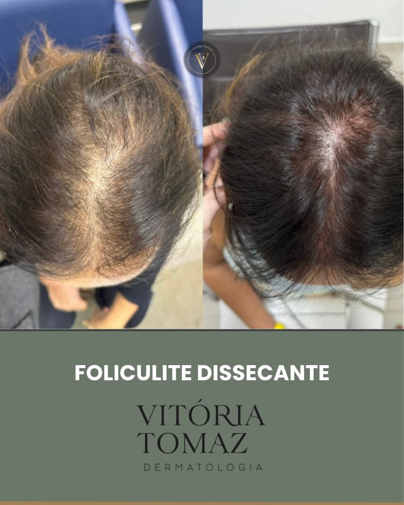Foliculite Dissecante