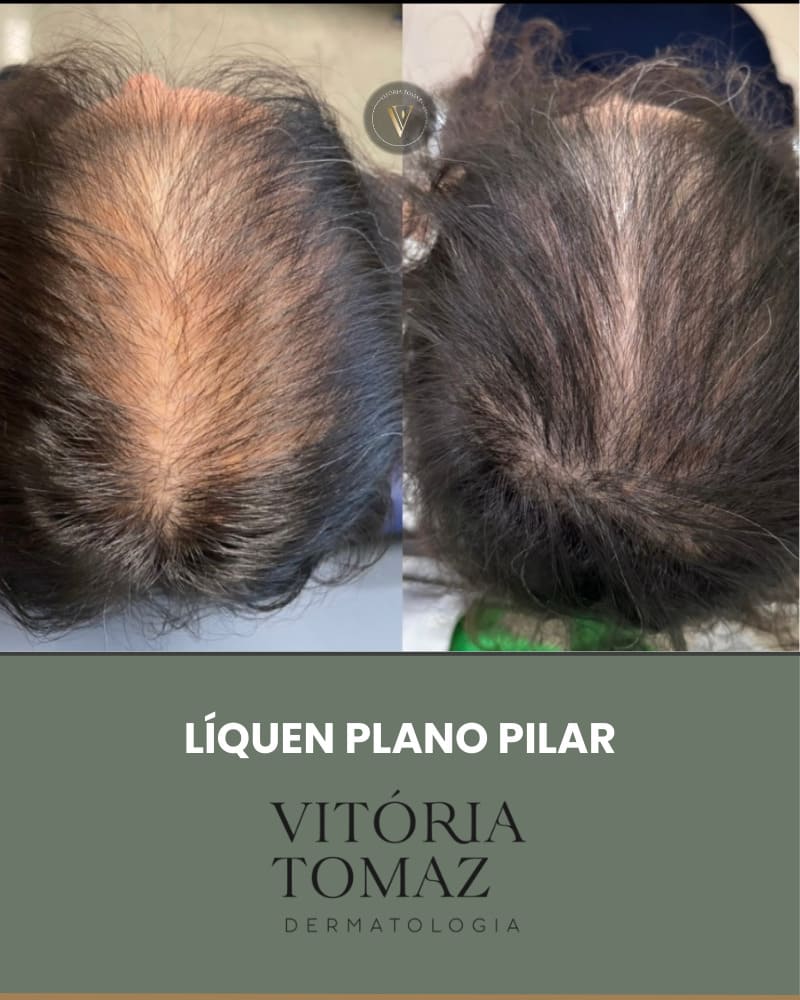 Líquen plano Pilar