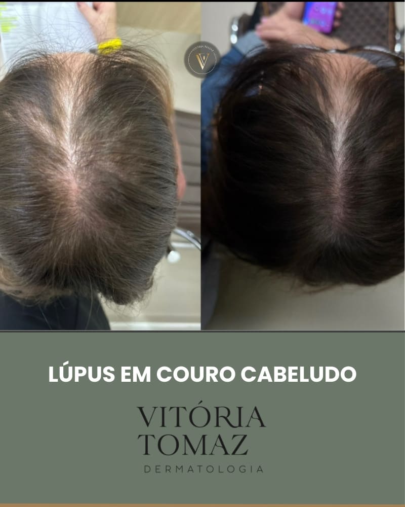 Lúpus em couro cabeludo