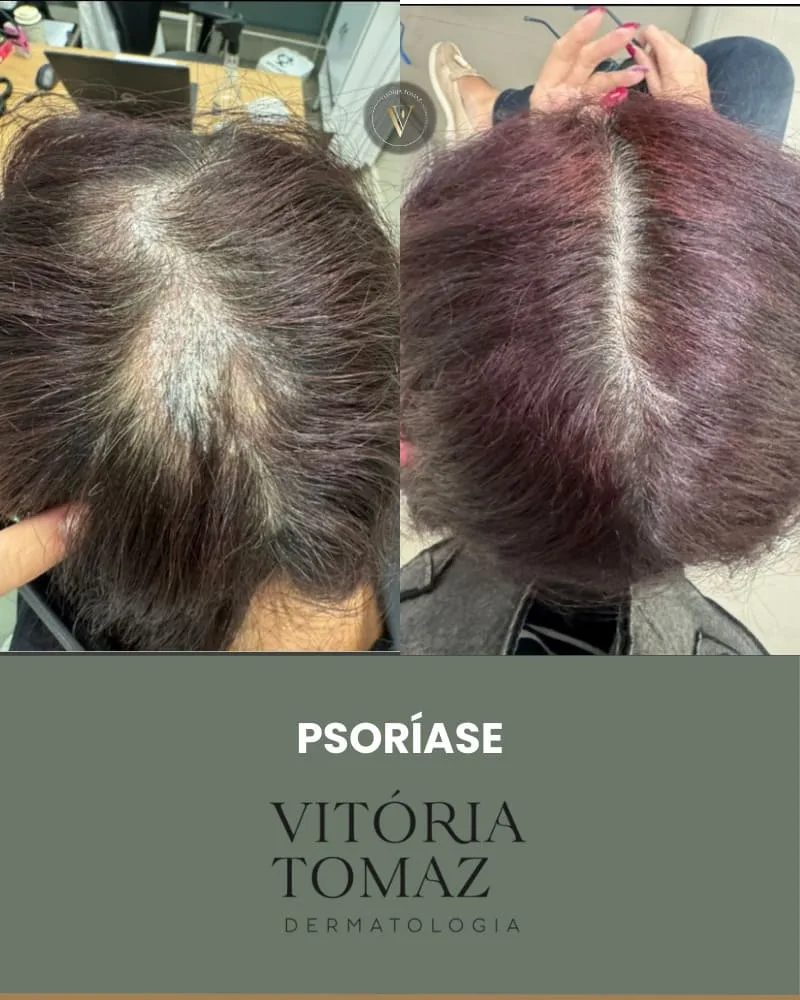 Psoríase