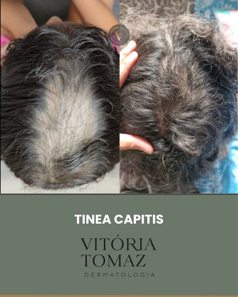 Tinea Capitis