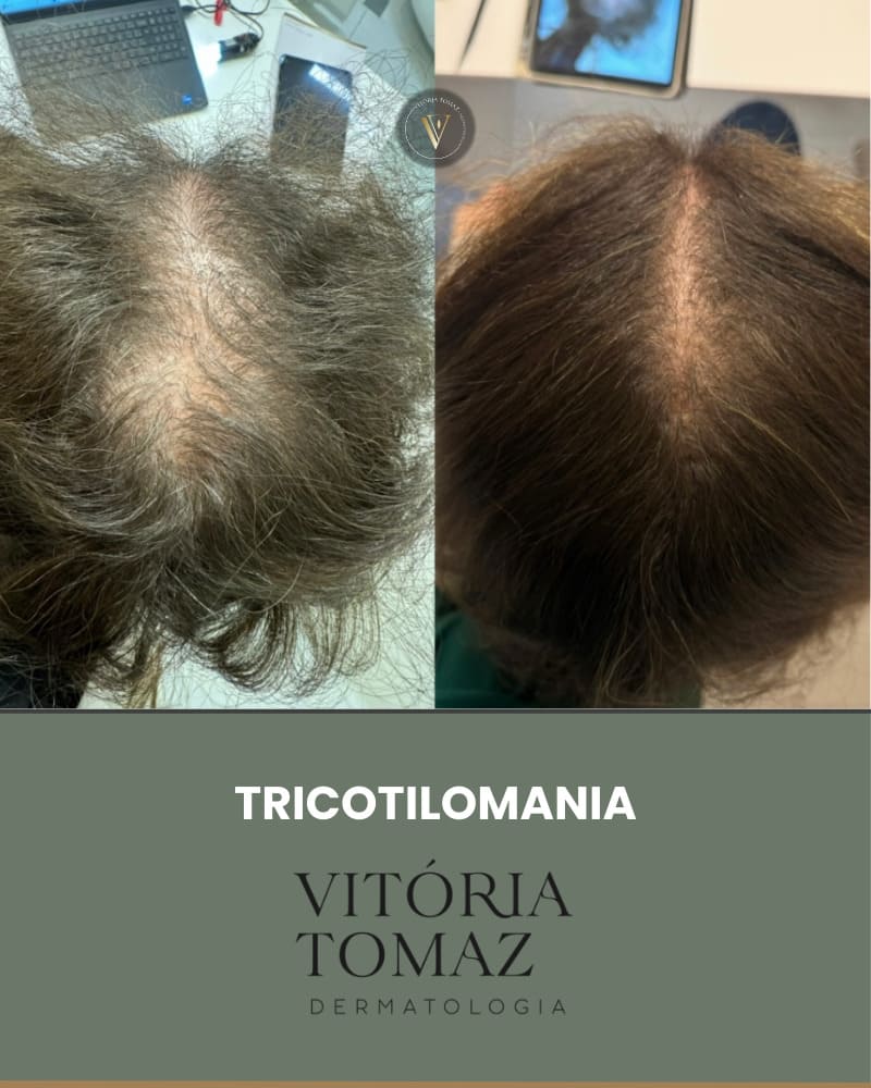 Tricotilomania