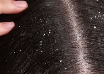 1 dermatite seborreica