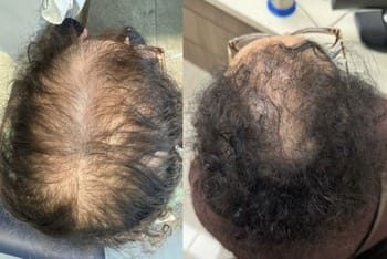 10 Líquen plano Pilar