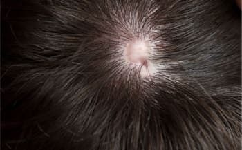 10 líquen plano pilar