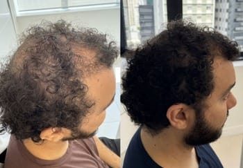 11 Alopecia androgenética masculina