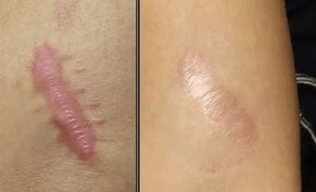 11 Cicatriz e queloide