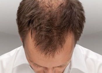 11 alopecia masculina