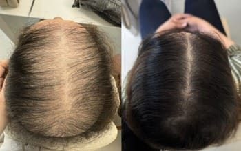 12 Alopecia androgenética feminina