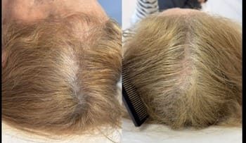 15 Distúrbio de haste