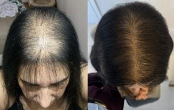 16 Eflúvio telógeno