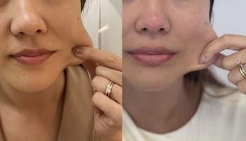 2 Bioestimulador colágeno