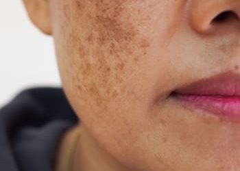 2 melasma