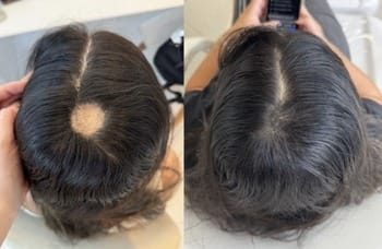 3 Alopecia areata
