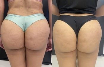 3 Preenchimento ácido hialurônico