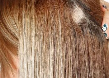 3 alopecia areata