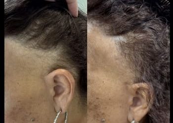 4 Alopecia fibrosante