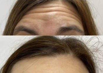 4 Botox