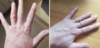 4 Psoríase corporal