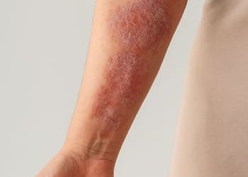 4 psoríase corporal