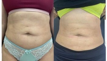 5 Esvaziador de gordura