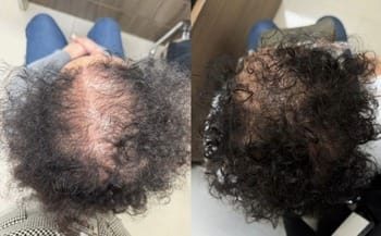 5 Lúpus no couro cabeludo