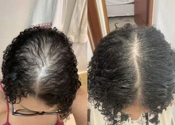 6 Alopecia por tração