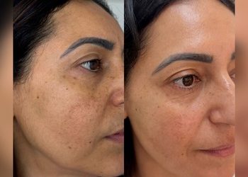 6 Microagulhamento facial