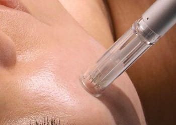 6 microagulhamento facial