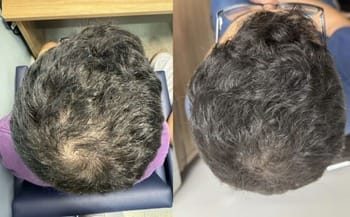 7 Foliculite decalvante