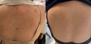 7 Peeling químico