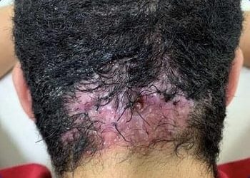 7 foliculite decalvante