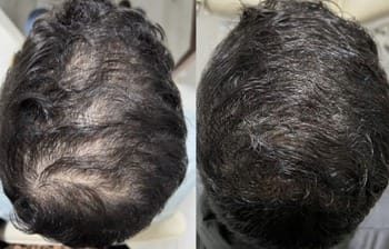 8 Foliculite dissecante