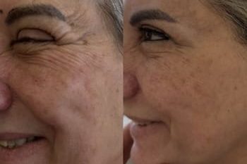 8 Skinbooster