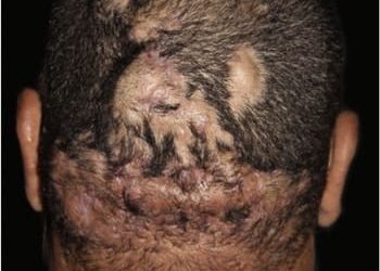 8 foliculite dissecante