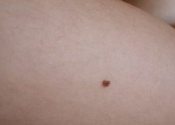 9 pintas e sinais (nevos)