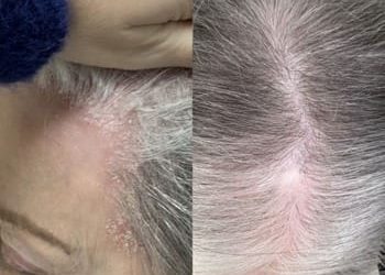 Dermatite seborreica