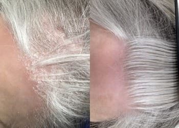 Psoríase no couro cabeludo